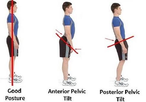 Anterior-pelvic-tilt.jpg