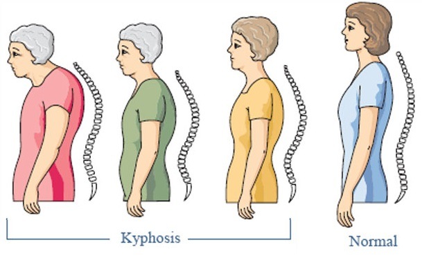Kyphosis-Normal.jpg